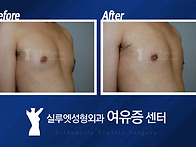 남자가슴 잡아봤더니 멍울..