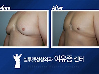 비만은 여유증 사이즈가 ..