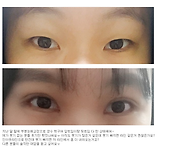눈성형 후기에용^^
