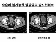 수술이 불가능하였던 방광..