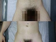 남자 브라질리언 왁싱＜고..