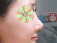 수술후