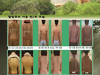 힐링큐브 임상사례