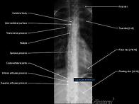 x-ray(thoracic)