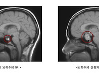 뇌하수체 종양 (..