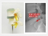&#65279;척추전방전위증을 수술없이 ..