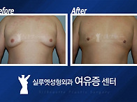 여유증원인 호르몬 &#46..