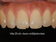 파절된 앞니의 레..