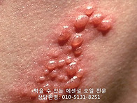 대상포진의 원인