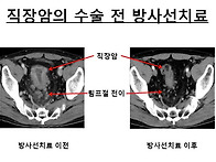 진행된 직장암의 수술전 ..