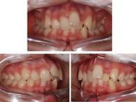 튀어나온 앞니의 ..