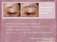 남자눈썹 시술직후 실제모..