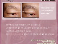 남자눈썹 시술직후 실제모..