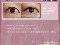 아이라인 시술직후 실제모..