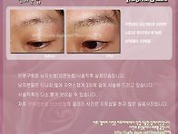 남자눈썹 시술직후 실제모..