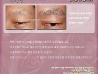 남자눈썹 시술직후 실제모..