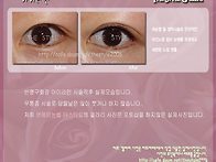 아이라인 시술직후 실제모..