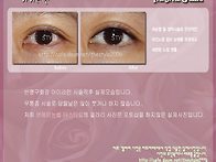 아이라인 시술직후 실제모..