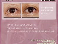 아이라인 시술직후 실제모..