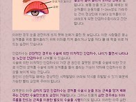 눈매교정 (안검하수)