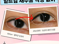 밑트임 재수술 짝짝이 될까..