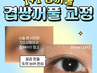 겹쌍 때문에 쌍꺼풀 비대칭..