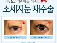 쌍수 라인 낮추기 두꺼운 ..