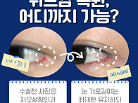 뒷트임후기 6개월차, ㄷ자..