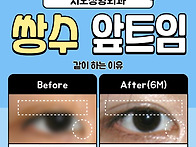 쌍수 앞트임 붓기가 안빠진..