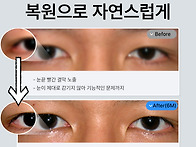 눈 가로길이 늘리려다 뒷밑..