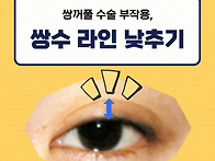 쌍꺼풀수술 부작용, 쌍수 ..