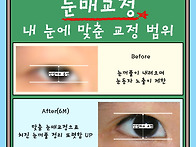 처진 눈꺼풀 수술 눈매교정..