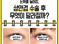 눈꺼풀 늘어짐 해결, 상안..