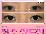 꼬막눈 쌍수, 세미아웃 쌍..