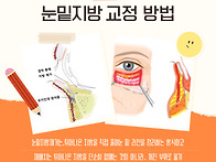 눈밑지방제거수술비용 얼마..
