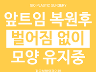 앞트임 복원 후 벌어짐 없..