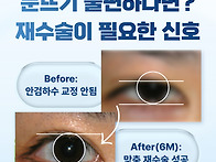 눈매교정 부작용, 뮬러근 ..