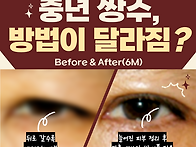 중년 쌍수, 눈처짐 심하면..
