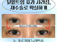 뒷밑트임 후 올라간 눈꼬리..