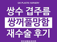 쌍수 겹주름, 쌍꺼풀재수술..