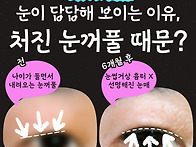 눈썹하거상술 흉터 없이 ..