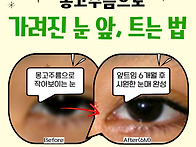 앞트임 수술 전후 답답한 ..