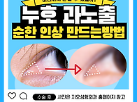 앞트임복원술 후 재트임 ..