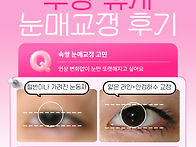 속쌍 눈매교정 후 안검하수..