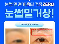 눈과 눈썹 사이 멀어졌다면..