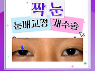 짝눈 눈매교정 재수술로 ..