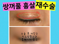 쌍꺼풀 흉살, 함몰흉 때문..