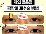 쌍수 짝짝이 재수술 비용 ..