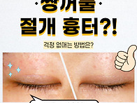 쌍수 절개 후기, 쌍꺼풀 ..