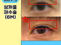 쌍수 재수술 후기, 겹쌍꺼..